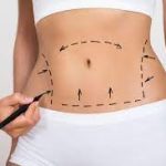 Non Surgical Liposuction In Chandigarh